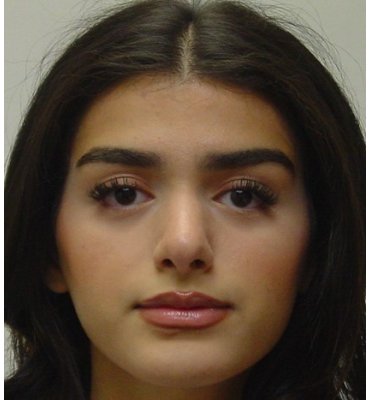 Primary Rhinoplasty